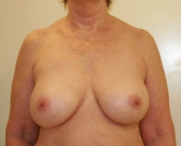 Feel Beautiful - Breast Revision San Diego 5 - After Photo